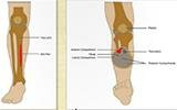 Shin Splints or Compartment Syndrome? Shin Splints or Compartment Syndrome?