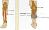 Shin Splints or Compartment Syndrome?